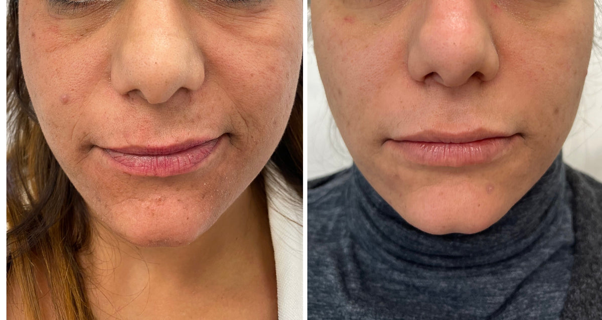 Before and after photo of a patient's lower face showing a more even skin tone, Dr Elif Benar Professional Vitamin C Serum