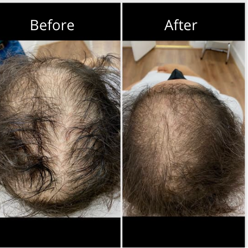 Before and after photo of a patient's scalp from above showing thicker-looking hair