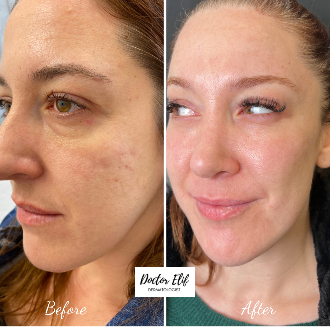Before and after photo of a patient's face showing brighter, more even skin, Doctor Elif dermatologist